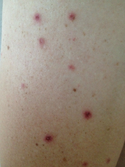 Necrotic Papules in a Teenager With Neck Pain | Consultant360